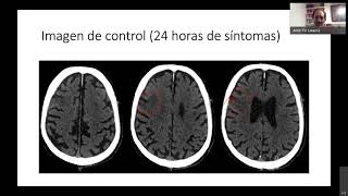 ENARM 2021 clase de Neurorradiología [upl. by Clarissa915]