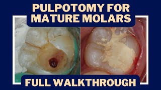 Pulpotomies for Irreversible Pulpitis The Rise of Vital Pulp Therapy  PDP133 [upl. by Eylloh]