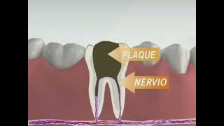 Understanding a Root Canal Procedure [upl. by Roxine]