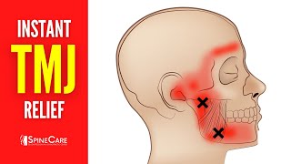 How to Relieve TMJ Pain at Home  30 SECOND RELIEF [upl. by Nner448]