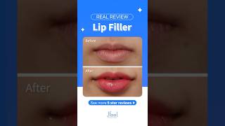 Disclosure the procedure process of Lip Filler✨ [upl. by Mort]