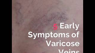 5 Early Symptoms of Varicose Veins [upl. by Candless]