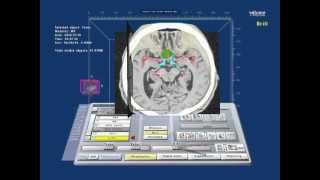 Virtual Reality planning of skull base surgery Tuberculum sellae meningioma [upl. by Peck57]