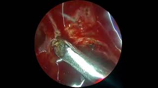 Anterior ethmoidal artery leak by prof dr jaskaran singh [upl. by Marybelle]