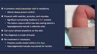 Transient Neonatal Pustular Melanosis [upl. by Eiramlatsyrc]