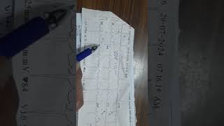 ECG MANY CONCEPTSBASICSIN 1 ECG LEFT ANTERIOR FASCICULAR BLOCK LEFT AXIS DEVIATION [upl. by Enawyd]