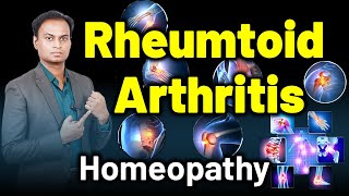 Rheumtoid Arthritis Chronic Inflammatory Arthritis  Dr Bharadwaz  HomeopathyTreatment and Cure [upl. by Epilif244]