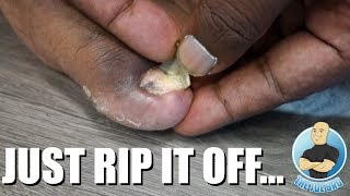 REMOVING A TOENAIL USING MY BARE HANDS [upl. by Dearden]