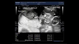 Twin Pregnancy of about 21 weeks with one fetus normal and the other with Hydrops Fetalis [upl. by Odrick]