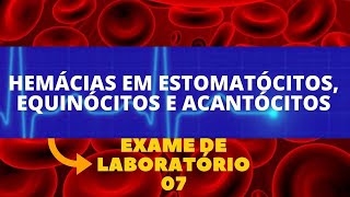 ESTOMATÓCITOS EQUINÓCITOS E ACANTÓCITOS  ALTERAÇÕES NO HEMOGRAMA HEMATOLOGIA [upl. by Fernyak]