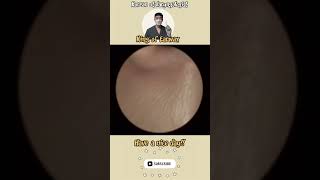 귀지형 콧물 부비동염 축농증 비염 코청소 이비인후과 rhinorrhea rhinitis sinusitis asmr ENT entdoctor [upl. by Carbo]