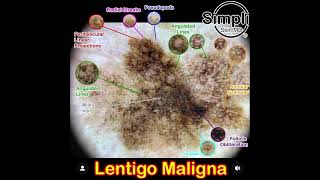 Lentigo Maligna Melanoma [upl. by Yreme]