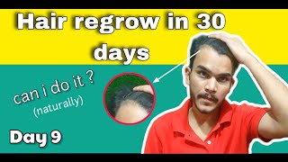 i will try to regrow my hair in 30 days  maturing hairline problem  hairfall naturally stop [upl. by Buford661]