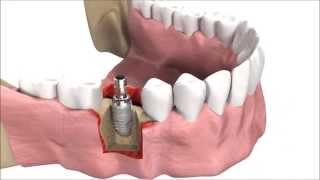 How DENTAL IMPLANTS are inserted  3D simulation [upl. by Gussy]