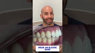 Invisalign And Elastic Bands To Fix Overbite [upl. by Nalhsa375]