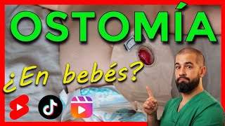 ¿Sabías que los bebés pueden tener ostomias [upl. by Darrej]