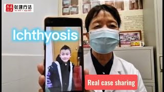 Ichthyosis real case sharing ichthyosis skincare dermatologist dryskinremedy [upl. by Aisiat]