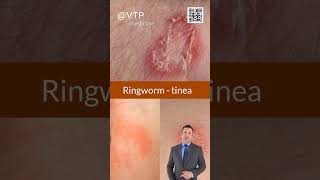 Understanding Ringworm Causes and Best Treatments for Patients  Lác đồng tiền [upl. by Guthry]