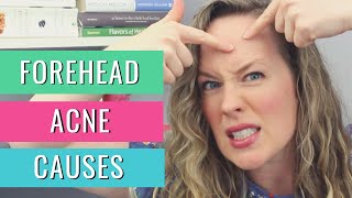 What causes forehead acne ZAP TINY FOREHEAD ACNE BUMPS FAST [upl. by Aicela]