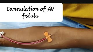 How to prick AV fistula First time Cannulation of AV fistula and Assessment [upl. by Lyudmila551]