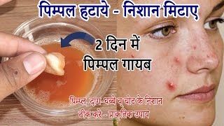 2 दिन Pimple Daag Dhabbe व Scars से पाए छुटकारा पाए हमेशा के लिए । Remove Pimple  Acne Treatment [upl. by Feeley]