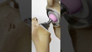 Total hip replacement explained 3D Animation [upl. by Lorenzana883]