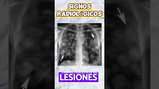 Signo Radiológicos de Metástasis Pulmonar Medicina Interna y Oncología ☝️ [upl. by Reube424]