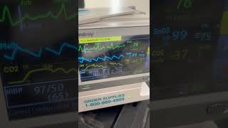 Branch Block Block BBB converts to Normal Sinus Rhythm NSR with 150mcg Phenylephrine IV [upl. by Renata334]