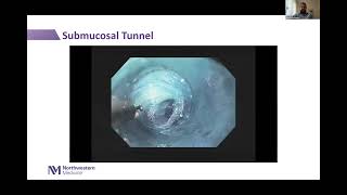 Third Space Intraluminal Endoscopy Webinar [upl. by Runkel]