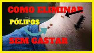 PÓLIPOS na PELE COMO eliminar FÁCIL e sem GASTAR [upl. by Deirdre970]