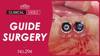 Use Surgical Guide for Advanced GBR Dr Kim Jaeyoon [upl. by Schramke]