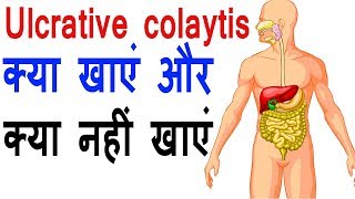 ulcerative colitis  क्या खायें क्या न खायें  Pet men sujan ka gharelu upay  desi nuskhe [upl. by Ahtela]