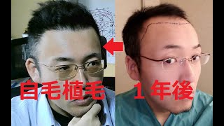 劇的変化！ 自毛植毛施術後365日1年経過 植毛で薄毛革命！第137回 Hair transplantation [upl. by Ivana]