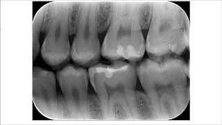 Proximal Caries Part 1 [upl. by Natye]