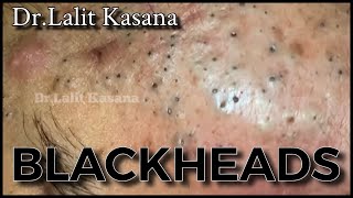 Best of Blackheads Removal by Dr Lalit Kasana  Repost [upl. by Larisa]