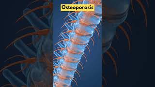 Osteoporosis Prevention Building Stronger Bones After 50 [upl. by Schwerin]