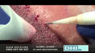 FIRSTDHITRIGASESSIONPART47apr13  Hair Transplant Doctor and Clinic [upl. by Stefanac]