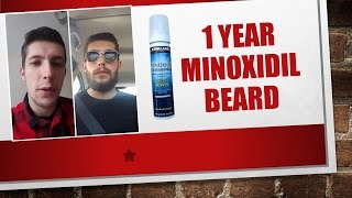 Minoxidil Beard  1 Year  Week 52  Minoxidil 5 for Beard Growth  Facialfuzzfridays [upl. by Eulaliah529]