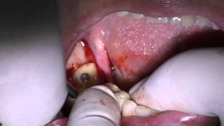 Alveolar ridge augmentation using onlay bone graft and bone splitting [upl. by Falo]