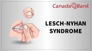 Lesch Nyhan Syndrome [upl. by Dnaltroc255]