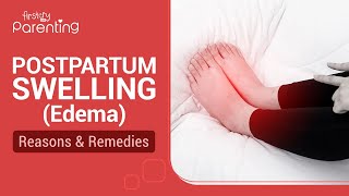 Postpartum Swelling Edema  Reasons and Remedies [upl. by Ahsemal]