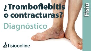 Cómo diferenciar una tromboflebitis de un dolor muscular de la pantorrilla o contractura muscular [upl. by Baron]