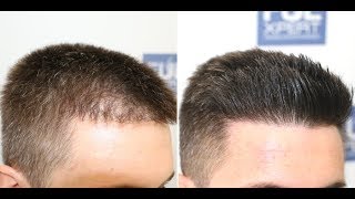 FUE Hair Transplant Repair 705 Grafts By Dr Juan Couto  FUEXPERT CLINIC Madrid Spain [upl. by Neyrb117]