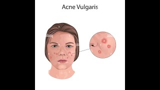 Acne Vulgaris [upl. by Shishko]