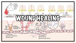 Wound Healing  Stages of healing and pathology [upl. by Ardnoel]