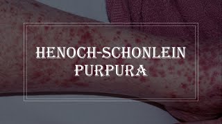 HenochSchonlein Purpura  purple rash on skin vasculitis [upl. by Ibrik]