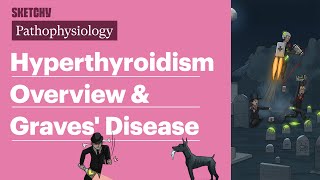 Hyperthyroidism Overview amp Graves Disease Internal Medicine  Sketchy Medical [upl. by Cristiano]