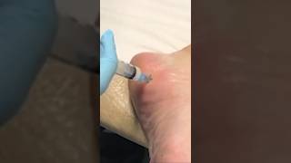 Plantar Fasciitis  policemans heel  heel bone pain  reels doctor shorts short Dr Raj M [upl. by Ahsenar586]