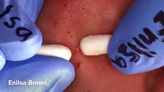 Blackheads Extractions on Christian Part 2 b [upl. by Aloisius]