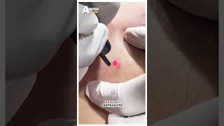 Mole removal by laser vs Cautry vs Excision [upl. by Herates]